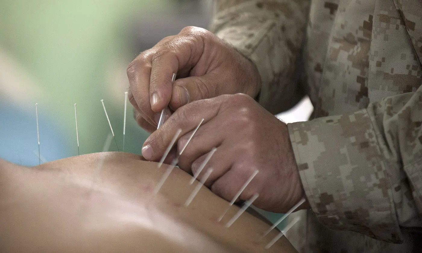 Acupuncture needles placed along a patient's back